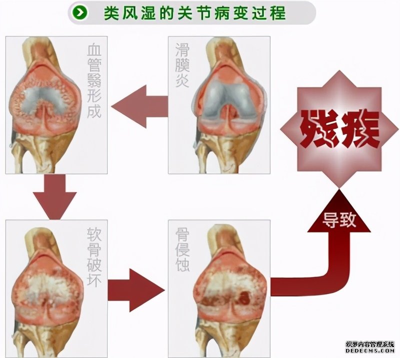這些病癥你中了幾項(xiàng)？超過4項(xiàng)患類風(fēng)濕性關(guān)節(jié)炎的幾率極高