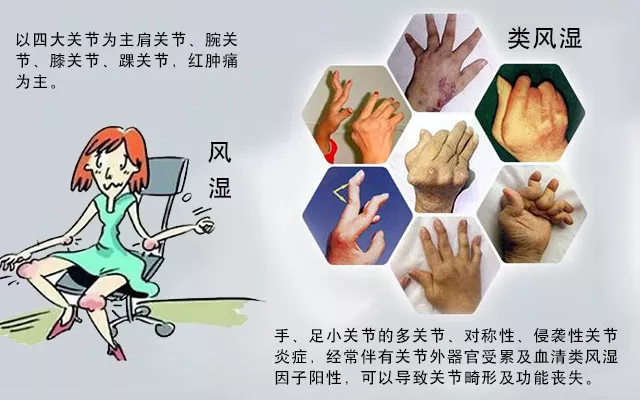 這些病癥你中了幾項(xiàng)？超過4項(xiàng)患類風(fēng)濕性關(guān)節(jié)炎的幾率極高